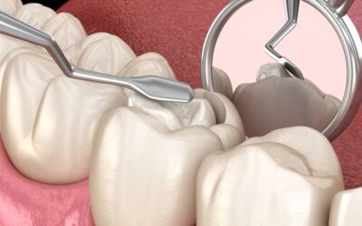 Composite Dental Fillings: What Are They and When Are They Used?