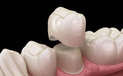 5 Reasons to Consider Dental Crowns for Better Oral Health