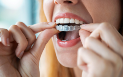 What to Expect During Your First Week with Invisalign Clear Aligners?