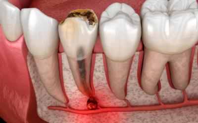 Can You Get a Root Canal Retreated If Infection Returns?